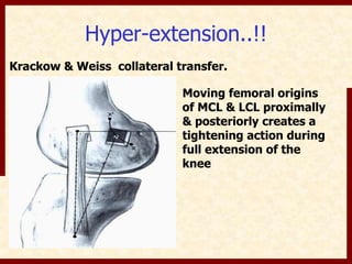 Hyper-extension..!! 
Krackow & Weiss collateral transfer. 
Moving femoral origins 
of MCL & LCL proximally 
& posteriorly creates a 
tightening action during 
full extension of the 
knee 
 
