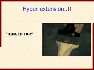 Hyper-extension..!! 
“HINGED TKR” 
 