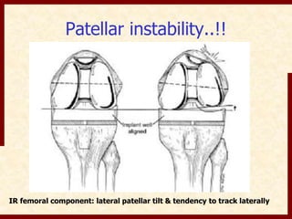 Patellar instability..!! 
IR femoral component: lateral patellar tilt & tendency to track laterally 
 