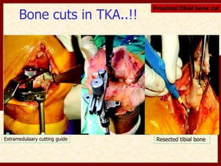 Bone cuts in TKA..!! 
Proximal tibial bone cut 
Extramedulaary cutting guide Resected tibial bone 
 