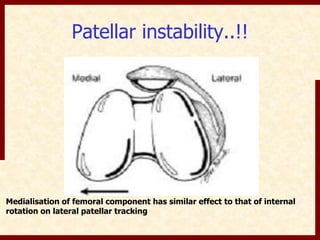 Patellar instability..!! 
Medialisation of femoral component has similar effect to that of internal 
rotation on lateral patellar tracking 
 