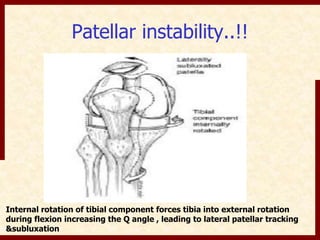 Patellar instability..!! 
Internal rotation of tibial component forces tibia into external rotation 
during flexion increasing the Q angle , leading to lateral patellar tracking 
&subluxation 
 