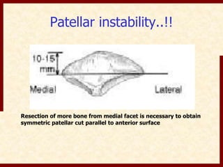 Patellar instability..!! 
Resection of more bone from medial facet is necessary to obtain 
symmetric patellar cut parallel to anterior surface 
 