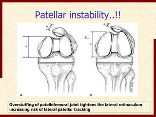 Patellar instability..!! 
Overstuffing of patellofemoral joint tightens the lateral retinaculum 
increasing risk of lateral patellar tracking 
 