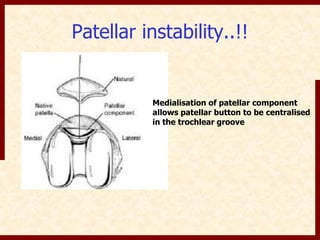 Patellar instability..!! 
Medialisation of patellar component 
allows patellar button to be centralised 
in the trochlear groove 
 