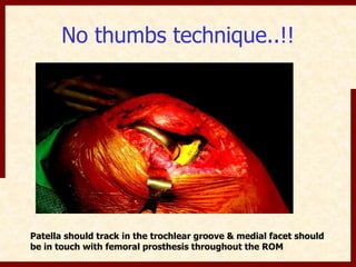 No thumbs technique..!! 
Patella should track in the trochlear groove & medial facet should 
be in touch with femoral prosthesis throughout the ROM 
 