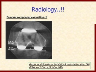 Radiology..!! 
Femoral component evaluation..!! 
Berger et al:Rotational instability & malrotation after TKA 
OCNA vol 32.No 4.October 2001 
 