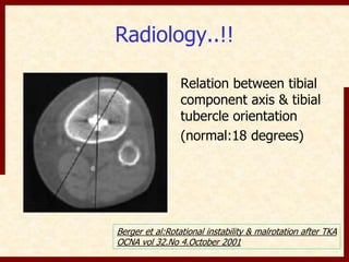 Radiology..!! 
Relation between tibial 
component axis & tibial 
tubercle orientation 
(normal:18 degrees) 
Berger et al:Rotational instability & malrotation after TKA 
OCNA vol 32.No 4.October 2001 
 