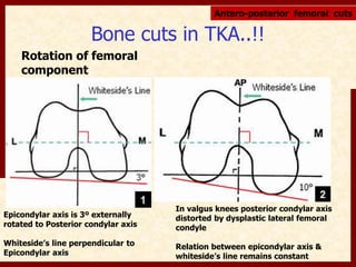 Bone cuts in TKA..!! 
Rotation of femoral 
component 
Antero-posterior femoral cuts 
Epicondylar axis is 3º externally 
rotated to Posterior condylar axis 
Whiteside’s line perpendicular to 
Epicondylar axis 
In valgus knees posterior condylar axis 
distorted by dysplastic lateral femoral 
condyle 
Relation between epicondylar axis & 
whiteside’s line remains constant 
 