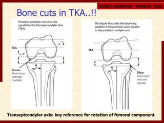 Bone cuts in TKA..!! 
Antero-posterior femoral cuts 
Transepicondylar axis: key reference for rotation of femoral component 
 
