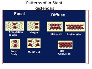 Patterns of In-Stent
Restenosis
Articulation
or Gap
Margin
Focal
Body
Multifocal
Focal
Intra-stent Proliferative
Total
Occlusion
Diffuse
 