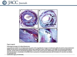 From: Current Treatment of In-Stent Restenosis
J Am Coll Cardiol. 2014;63(24):2659-2673. doi:10.1016/j.jacc.2014.02.545
Figure Legend:
Pathological Images of In-Stent Restenosis
Low-power (A and B, 4×) and high-power (C and D, 10×) magnification images of restenosis within (A and C) a bare-metal stent
(BMS) and (B and D) a drug-eluting stent (DES), both implanted 5 years antemortem. In the BMS, the dominant pathology is
smooth muscle cell-rich neointimal hyperplasia. There is also some chronic inflammation with neovascularization around
stent struts (green arrowhead). In the DES, there is presence of neoatherosclerosis with formation of a necrotic core (black
arrowheads) and
calcification (grey arrowheads).
.
 