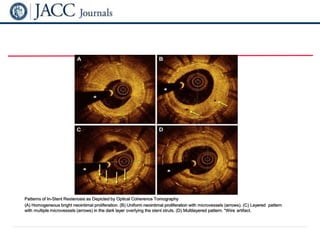 From: Current Treatment of In-Stent Restenosis
J Am Coll Cardiol. 2014;63(24):2659-2673. doi:10.1016/j.jacc.2014.02.545
Figure Legend:
Patterns of In-Stent Restenosis as Depicted by Optical Coherence Tomography
(A) Homogeneous bright neointimal proliferation. (B) Uniform neointimal proliferation with microvessels (arrows). (C) Layered pattern
with multiple microvessels (arrows) in the dark layer overlying the stent struts. (D) Multilayered pattern. *Wire artifact.
 