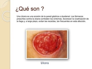 ¿Qué son ?
Una úlcera es una erosión de la pared gástrica o duodenal. Los fármacos
prescritos contra la úlcera combaten los síntomas, favorecen la cicatrización de
la llaga y, a largo plazo, evitan las recaídas, tan frecuentes en esta afección.
 