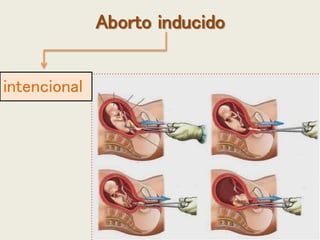 Aborto inducido
intencional
 