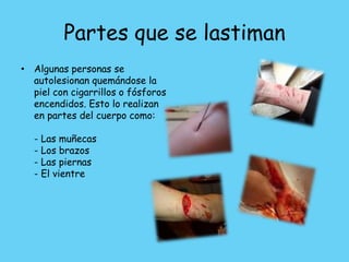 Partes que se lastiman
• Algunas personas se
  autolesionan quemándose la
  piel con cigarrillos o fósforos
  encendidos. Esto lo realizan
  en partes del cuerpo como:

  - Las muñecas
  - Los brazos
  - Las piernas
  - El vientre
 