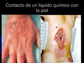 Contacto de un liquido químico con la piel 