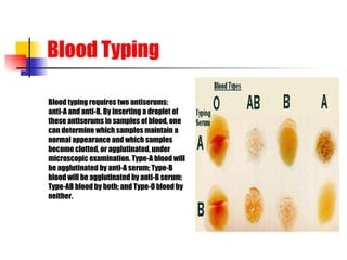 Blood Typing Blood typing requires two antiserums:  anti-A and anti-B. By inserting a droplet of  these antiserums in samples of blood, one  can determine which samples maintain a  normal appearance and which samples  become clotted, or agglutinated, under  microscopic examination. Type-A blood will  be agglutinated by anti-A serum; Type-B  blood will be agglutinated by anti-B serum;  Type-AB blood by both; and Type-O blood by  neither.  