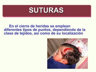 SUTURAS   En el cierre de heridas se emplean  diferentes tipos de puntos, dependiendo de la clase de tejidos, así como de su localización 