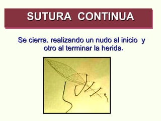 Se cierra. realizando un nudo al inicio  y otro al terminar la herida . SUTURA  CONTINUA   