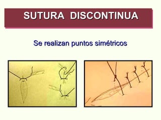 SUTURA  DISCONTINUA   Se realizan puntos simétricos 