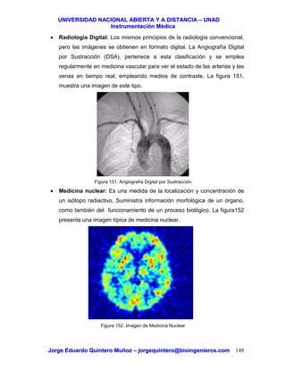 UUNNIIVVEERRSSIIDDAADD NNAACCIIOONNAALL AABBIIEERRTTAA YY AA DDIISSTTAANNCCIIAA –– UUNNAADD
IInnssttrruummeennttaacciióónn MMééddiiccaa
JJoorrggee EEdduuaarrddoo QQuuiinntteerroo MMuuññoozz –– jjoorrggeeqquuiinntteerroo@@bbiiooiinnggeenniieerrooss..ccoomm 148
• Radiología Digital: Los mismos principios de la radiología convencional,
pero las imágenes se obtienen en formato digital. La Angiografía Digital
por Sustracción (DSA), pertenece a esta clasificación y se emplea
regularmente en medicina vascular para ver el estado de las arterias y las
venas en tiempo real, empleando medios de contraste. La figura 151,
muestra una imagen de este tipo.
Figura 151. Angiografía Digital por Sustracción
• Medicina nuclear: Es una medida de la localización y concentración de
un isótopo radiactivo. Suministra información morfológica de un órgano,
como también del funcionamiento de un proceso biológico. La figura152
presenta una imagen típica de medicina nuclear.
Figura 152. Imagen de Medicina Nuclear
 