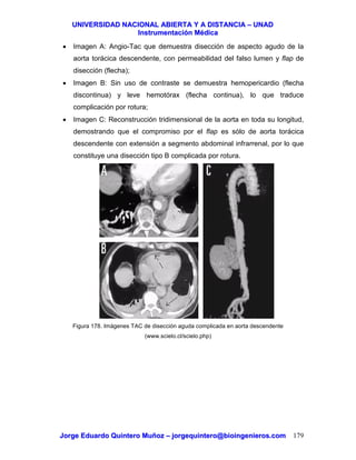 UUNNIIVVEERRSSIIDDAADD NNAACCIIOONNAALL AABBIIEERRTTAA YY AA DDIISSTTAANNCCIIAA –– UUNNAADD
IInnssttrruummeennttaacciióónn MMééddiiccaa
JJoorrggee EEdduuaarrddoo QQuuiinntteerroo MMuuññoozz –– jjoorrggeeqquuiinntteerroo@@bbiiooiinnggeenniieerrooss..ccoomm 179
• Imagen A: Angio-Tac que demuestra disección de aspecto agudo de la
aorta torácica descendente, con permeabilidad del falso lumen y flap de
disección (flecha);
• Imagen B: Sin uso de contraste se demuestra hemopericardio (flecha
discontinua) y leve hemotórax (flecha continua), lo que traduce
complicación por rotura;
• Imagen C: Reconstrucción tridimensional de la aorta en toda su longitud,
demostrando que el compromiso por el flap es sólo de aorta torácica
descendente con extensión a segmento abdominal infrarrenal, por lo que
constituye una disección tipo B complicada por rotura.
Figura 178. Imágenes TAC de disección aguda complicada en aorta descendente
(www.scielo.cl/scielo.php)
 