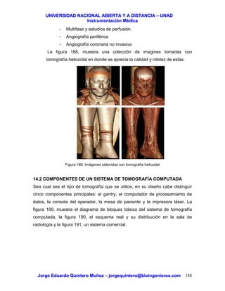 UUNNIIVVEERRSSIIDDAADD NNAACCIIOONNAALL AABBIIEERRTTAA YY AA DDIISSTTAANNCCIIAA –– UUNNAADD
IInnssttrruummeennttaacciióónn MMééddiiccaa
JJoorrggee EEdduuaarrddoo QQuuiinntteerroo MMuuññoozz –– jjoorrggeeqquuiinntteerroo@@bbiiooiinnggeenniieerrooss..ccoomm 188
- Multifase y estudios de perfusión.
- Angiografía periférica
- Angiografía coronaria no invasiva
La figura 188, muestra una colección de imagines tomadas con
tomografía helicoidal en donde se aprecia la calidad y nitidez de estas.
Figura 188. Imágenes obtenidas con tomografía helicoidal
14.2 COMPONENTES DE UN SISTEMA DE TOMOGRAFÍA COMPUTADA
Sea cual sea el tipo de tomografía que se utilice, en su diseño cabe distinguir
cinco componentes principales: el gantry, el computador de procesamiento de
datos, la consola del operador, la mesa de paciente y la impresora láser. La
figura 189, muestra el diagrama de bloques básico del sistema de tomografía
computada, la figura 190, el esquema real y su distribución en la sala de
radiología y la figura 191, un sistema comercial.
 