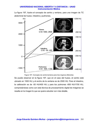 UUNNIIVVEERRSSIIDDAADD NNAACCIIOONNAALL AABBIIEERRTTAA YY AA DDIISSTTAANNCCIIAA –– UUNNAADD
IInnssttrruummeennttaacciióónn MMééddiiccaa
JJoorrggee EEdduuaarrddoo QQuuiinntteerroo MMuuññoozz –– jjoorrggeeqquuiinntteerroo@@bbiiooiinnggeenniieerrooss..ccoomm 203
La figura 197, ilustra el concepto de centro y ventana, para una imagen de TC
abdominal de hueso, intestino y pulmones.
Figura 197. Concepto de centro/ventana para tres órganos diferentes
Se puede observar en la figura 197, que en el caso del hueso, el centro está
ubicado en 1000 HU y el ancho de la ventana es de 2500 HU. Para el intestino,
la calibración es de -50 HU/400 HU y para los pulmones -600 HU/1700 HU,
comprobándose como con esta técnica de procesamiento digital de imágenes se
resalta en la imagen lo que se quiere estudiar con más detalle.
Hueso
Intestino
Pulmones
 