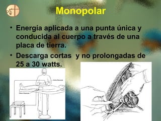 Monopolar
• Energía aplicada a una punta única y
  conducida al cuerpo a través de una
  placa de tierra.
• Descarga cortas y no prolongadas de
  25 a 30 watts.
 