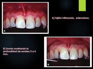 Instrumentos y principios de la instrumentación en periodoncia