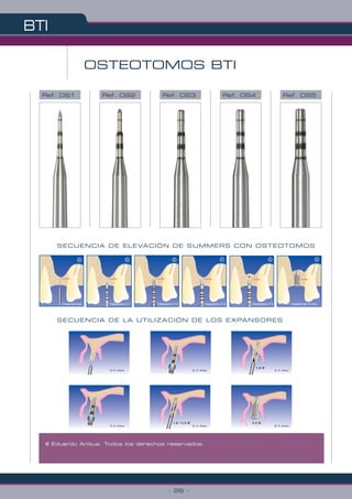 BTI
- 26 -
© Eduardo Anitua. Todos los derechos reservados.
OSTEOTOMOS BTI
Ref. OS1
SECUENCIA DE ELEVACIÓN DE SUMMERS CON OSTEOTOMOS
SECUENCIA DE LA UTILIZACIÓN DE LOS EXPANSORES
Ref. OS2 Ref. OS3 Ref. OS4 Ref. OS5
1,5 mm.
II
©
1,5 mm.
I
©
1,5 mm.
©
1,5 mm.
III Osteotomo nº 3
©
Osteotomo nº 3
1,5 mm.
III
©
Implante de 10 mm.
1,5 mm.
©
Fresa de inicio Osteotomo nº 1 Osteotomo nº 2
1,8 / 2,5 Ø
1,8 Ø
3,3 Ø
 