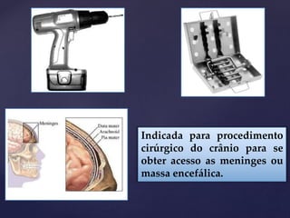 Indicada para procedimento
cirúrgico do crânio para se
obter acesso as meninges ou
massa encefálica.
 