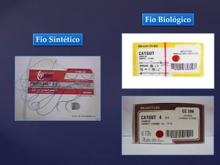Fio Sintético
Fio Biológico
 