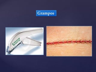 Grampos
 