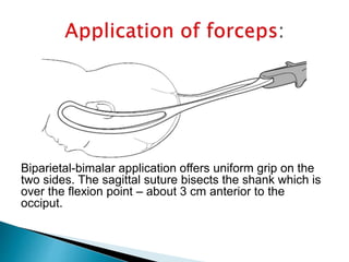  Forceps used are – Long curved with or
without axis traction device & Kjelland’s
forceps.
 INDICATION – Following manua...
