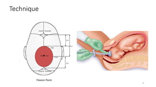 Technique
18
.
Flexion Point
 