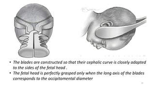 33
• The blades are constructed so that their cephalic curve is closely adapted
to the sides of the fetal head .
• The fetal head is perfectly grasped only when the long axis of the blades
corresponds to the occipitomental diameter
 