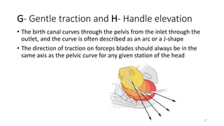 G- Gentle traction and H- Handle elevation
• The birth canal curves through the pelvis from the inlet through the
outlet, and the curve is often described as an arc or a J-shape
• The direction of traction on forceps blades should always be in the
same axis as the pelvic curve for any given station of the head
37
 