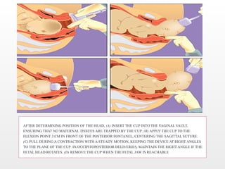 instrumentaldelivery obstetrics and gynaecology | PPTX