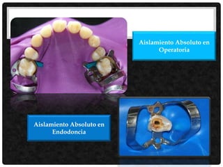 Aislamiento Absoluto en
Operatoria
Aislamiento Absoluto en
Endodoncia
 