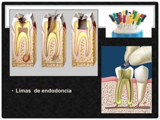 • Limas de endodoncia
 