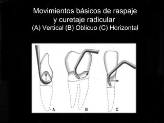 Movimientos básicos de raspaje
y curetaje radicular
(A) Vertical (B) Oblicuo (C) Horizontal
 