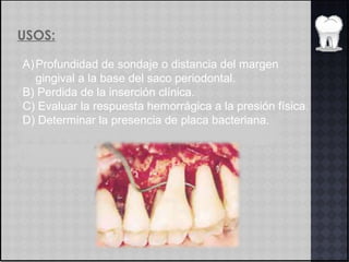 USOS:
A)Profundidad de sondaje o distancia del margen
gingival a la base del saco periodontal.
B) Perdida de la inserción clínica.
C) Evaluar la respuesta hemorrágica a la presión física.
D) Determinar la presencia de placa bacteriana.
 