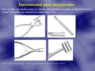 Instrumental para manejo oseo
Para el retiro de injertos oseos se utilizan ademas de los cinceles ya descritos la pinza
Gubia, el martillo y el raspadorde hueso (figura 16).

Figura 16. instrumentos para manejo óseo. A. Molino de Hueso. B. Raspador de Hueso c. pinza gubia. D. Martillo.

 