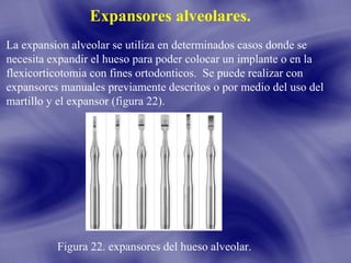 Expansores alveolares.
La expansion alveolar se utiliza en determinados casos donde se
necesita expandir el hueso para poder colocar un implante o en la
flexicorticotomia con fines ortodonticos. Se puede realizar con
expansores manuales previamente descritos o por medio del uso del
martillo y el expansor (figura 22).

Figura 22. expansores del hueso alveolar.

 