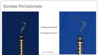 Sonda periodontal
“Carolina do Norte”
Sondas Periodontais
Foto: autoria própria
 