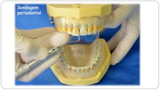 Sondagem
periodontal
Foto: autoria própria
 