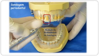 Sondagem
periodontal
Medição da
Profundidade
de Sondagem
Foto: autoria própria
 