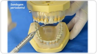 Sondagem
periodontal
Foto: autoria própria
 